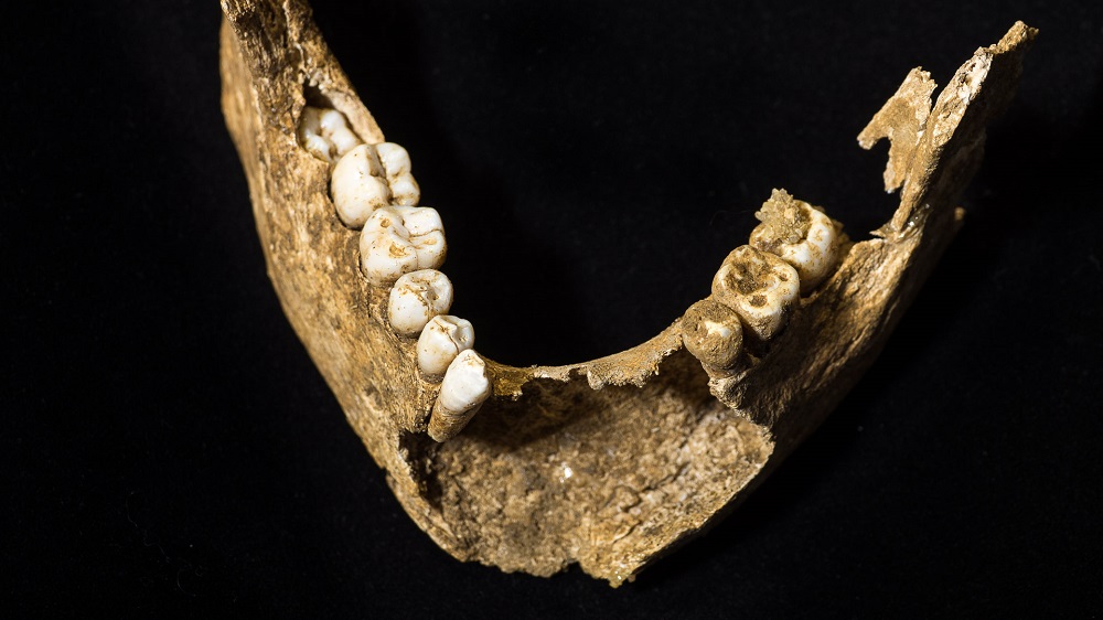 The mandible, or lower jaw, shows extensive damage caused by a chronic abscess due to dental trauma that resulted in fractured front teeth. (Photo by Bruce Dale. Courtesy of Martin D. Levin)