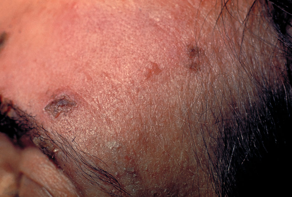 The first symptoms of shingles may be pain, itching, or tingling in one area of the body. About one to five days later, a rash will appear in that area. The rash consists of blisters that usually scab over in seven to 10 days and clear up in two to four weeks. The rash is usually limited to one side of the body. Shingles can also cause fever, headache, chills and upset stomach.(HNNDaily photo/Courtesy www.cdc.gov)