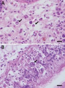 Panel A (top) shows the original form of the Dermo parasite Perkinsus marinus, with black arrows indicating typical Dermo cells and the white arrow a dividing form, all infecting connective tissues deep inside an oyster. Panel B shows the new form of the parasite, much smaller, with the arrow indicating a mass of dozens of Dermo cells inside a single oyster blood cell, and primarily infecting the lining of the stomach and gut. (R. Carnegie/VIMS/WYDAILY)